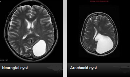 Neuroglial cyst and Arachnoid cyst mri