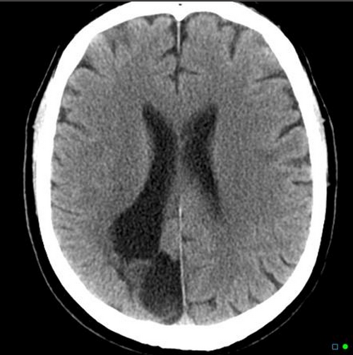 Porencephaly Cyst CT