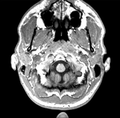 porencephalic cyst radiology