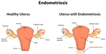Pregnancy Endometriosis 