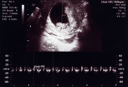 10 Weeks Ultra Heartbeat