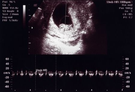 10 weeks ultra heartbeat 10 Weeks Ultra Heartbeat