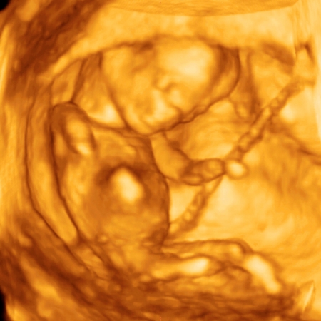 4d Pregnancy Ultrasound Scan