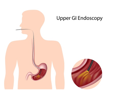Upper Gastrointestinal Endoscopy