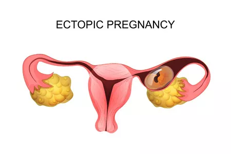 Ectopic Pregnancy