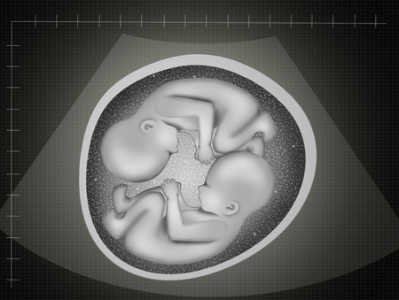 ultrasound of twins Ultrasound of Twins