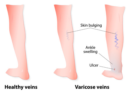 19 Weeks Pregnant Varicose Veins