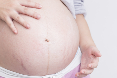 21 Weeks Pregnant Stretch Marks