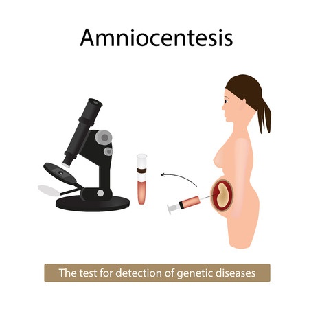 Amniocentesis