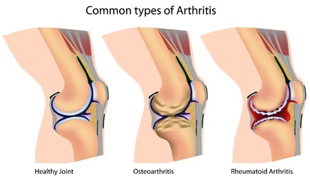 Types of Arthritis
