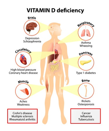 Vitamin D Deficiency