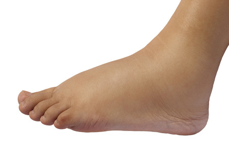 22 Weeks Oedema of Feet