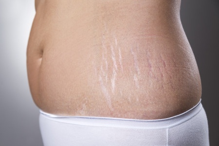 Post Pregnancy Stretch Marks