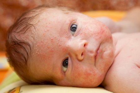 Newborn Baby Acne