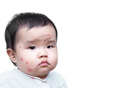 Baby 10 Months Old Insect Bites
