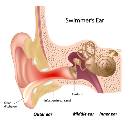 Ear Infections - Swimmer's Ear