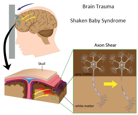 Causes of Shaken Baby Syndrome