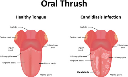 Causes of Thrush