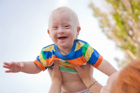 Global Development Delay - Downs Syndrome