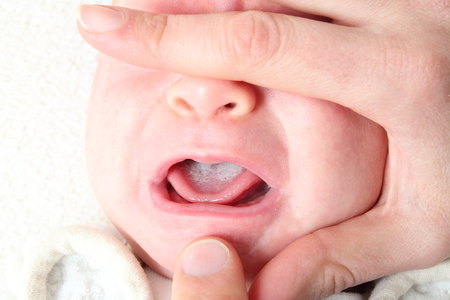 Thrush in Newborn Babies