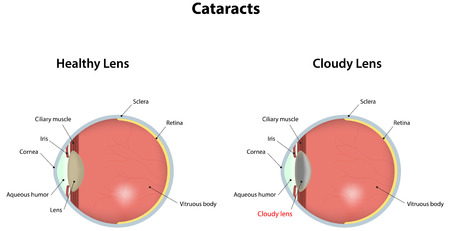 Cataract Development