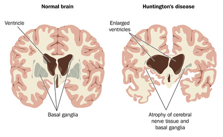Causes of Huntington's Disease