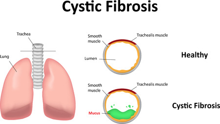 Cystic Fibrosis Causes