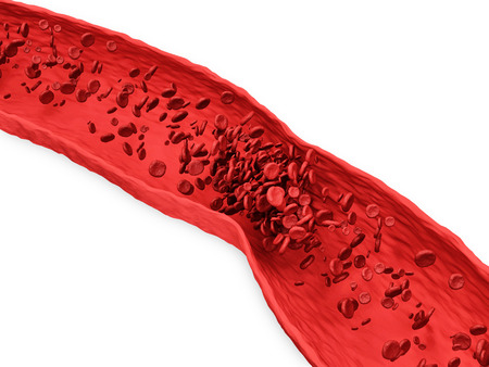 Hemophilia Blood Clots