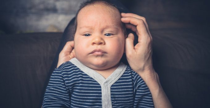 Baby Cradle Cap