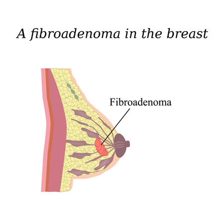Fibroadenoma - Breastfeeding and Cancer