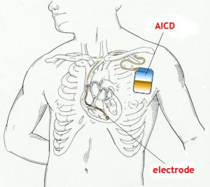 By Gejordan - Own work, Public Domain, https://commons.wikimedia.org/w/index.php?curid=5231160 AICD Implanted Cardioverter Defibrillator