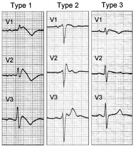 By see above - Napolitano C, Priori SG. Brugada syndrome. Orphanet J Rare Dis. 1, 35. 2006. doi:10.1186/1750-1172-1-35. PMID 16972995., CC BY 2.0, https://commons.wikimedia.org/w/index.php?curid=3900813 Brugada Syndrome type 1,2,3
