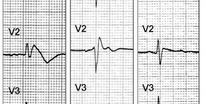 Brugada