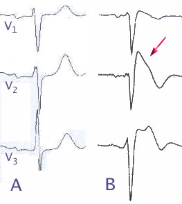 By J. Heuser JHeuser - Own work, CC BY-SA 3.0, https://commons.wikimedia.org/w/index.php?curid=554687 Brugada Syndrom EKG Schema
