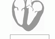 Wolff Parkinson White Syndrome