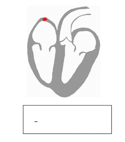 By Kalumet - selbst erstellt = Own work, CC BY-SA 3.0, https://commons.wikimedia.org/w/index.php?curid=438152 Wolff Parkinson White Syndrome